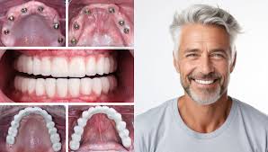 price of full dental implants