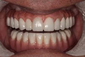 price of full mouth dental implants
