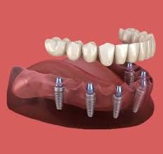 price of full set of dental implants