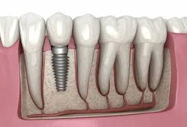 screw in teeth price