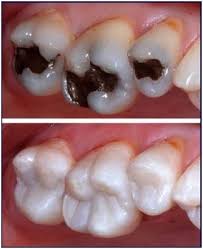 teeth restoration price