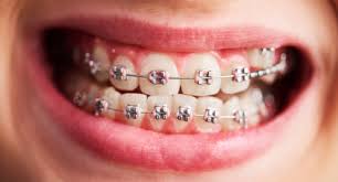 teeth setting cost