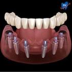 titanium dental implant cost