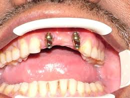 tooth replacement price