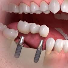 tooth transplant cost