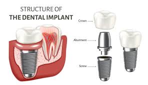 types of dental implants cost