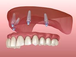 upper dental implants cost