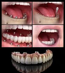 whole mouth dental implants cost