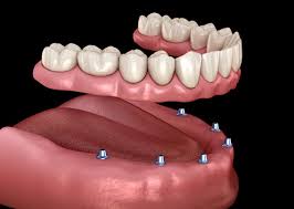 whole mouth dental implants price
